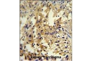 U antibody (C-term) (ABIN654948 and ABIN2844589) immunohistochemistry analysis in formalin fixed and paraffin embedded human kidney carcinoma followed by peroxidase conjugation of the secondary antibody and DAB staining. (UPP2 Antikörper  (C-Term))