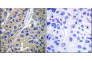 Immunohistochemistry analysis of paraffin-embedded human breast carcinoma, using Keratin 18 (Phospho-Ser33) Antibody. (Cytokeratin 18 Antikörper  (pSer34))