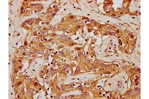 IHC image of nforHU diluted at 1:20 and staining in paraffin-embedded human liver cancer performed on a Leica BondTM system. (HIST1H1E Antikörper  (AA 57-69))