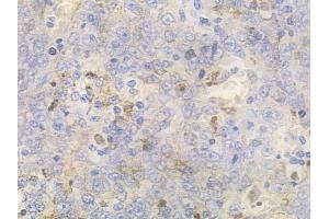 ABIN6256225 and ABIN6267330 at 1/100 staining human melanoma by IHC-P.