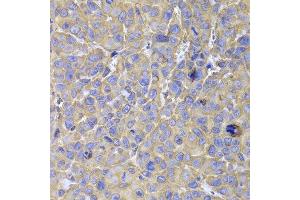 Immunohistochemistry of paraffin-embedded mouse cancer using HSPA14 antibody at dilution of 1:100 (x400 lens). (HSPA14 Antikörper)