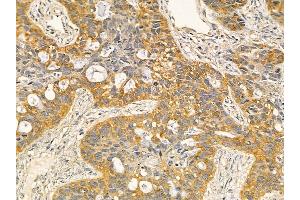 GPR120 Mouse Monoclonal Antibody at 1/100 staining human lung cancer and adjacent non-tumor tissue by IHC-P.