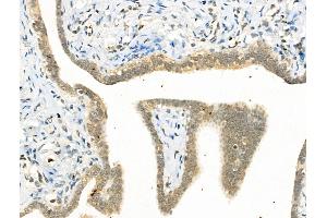 Phospho-YY1 (Ser365) Antibody at 1/100 staining Human ovarian cancer by IHC-P. (YY1 Antikörper  (pSer365))