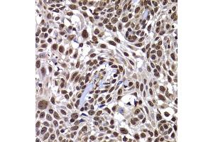 Immunohistochemistry of paraffin-embedded human well-differentiated squamous skin carcinoma using DNAJB6 antibody (ABIN5974242) at dilution of 1/100 (40x lens). (DNAJB6 Antikörper)