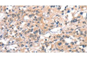 Immunohistochemistry of paraffin-embedded Human thyroid cancer tissue using CYP2D6 Polyclonal Antibody at dilution 1:40 (CYP2D6 Antikörper)