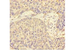 Immunohistochemistry of paraffin-embedded human ovarian cancer using ABIN7170819 at dilution of 1:100 (STIP1 Antikörper  (AA 1-543))
