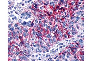 Anti-GPR133 antibody IHC of human Ovary, Carcinoma. (G Protein-Coupled Receptor 133 Antikörper  (N-Term))