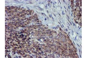 Immunohistochemical staining of paraffin-embedded Adenocarcinoma of Human breast tissue using anti-ALOX15 mouse monoclonal antibody. (ALOX15 Antikörper)