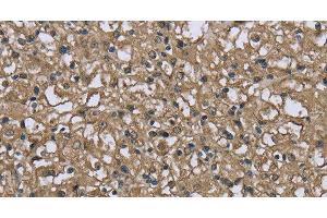 Immunohistochemistry of paraffin-embedded Human prostate cancer using FBP1 Polyclonal Antibody at dilution of 1:40 (FBP1 Antikörper)