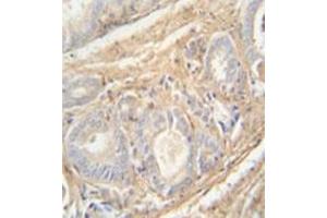 Immunohistochemistry analysis in formalin fixed and paraffin embedded human prostate carcinoma reacted with PCOTH Antibody (Center) followed by peroxidase conjugation of the secondary antibody and DAB staining.