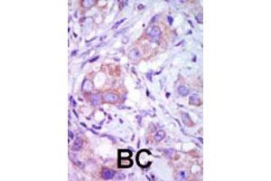 Formalin-fixed and paraffin-embedded human cancer tissue reacted with the MAP3K9 polyclonal antibody  , which was peroxidase-conjugated to the secondary antibody, followed by DAB staining. (MAP3K9 Antikörper  (C-Term))