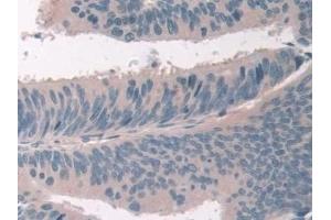 Detection of USP6NL in Human Colorectal cancer Tissue using Polyclonal Antibody to USP6 N-Terminal Like Protein (USP6NL)