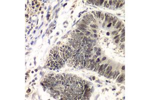 Immunohistochemistry of paraffin-embedded human colon carcinoma using SMARCA4 antibody at dilution of 1:100 (x40 lens).