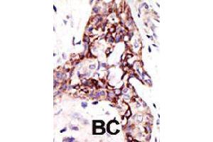 Formalin-fixed and paraffin-embedded human cancer tissue reacted with ARL3 polyclonal antibody  , which was peroxidase-conjugated to the secondary antibody, followed by DAB staining . (ARL3 Antikörper  (C-Term))