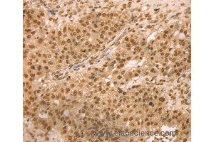 Immunohistochemistry of Human breast cancer using SNX8 Polyclonal Antibody at dilution of 1:25 (SNX8 Antikörper)