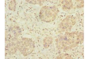 Immunohistochemistry of paraffin-embedded human gastric cancer using ABIN7175005 at dilution of 1:100 (MRPL46 Antikörper  (AA 28-153))