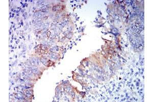 Immunohistochemical analysis of paraffin-embedded rectum cancer tissues using GRIA2 mouse mAb with DAB staining.
