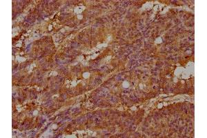 IHC image of ABIN7157186 diluted at 1:100 and staining in paraffin-embedded human colon cancer performed on a Leica BondTM system. (KALRN Antikörper  (AA 2410-2661))