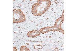 Immunohistochemistry of paraffin-embedded human breast cancer using ABCC5 antibody (ABIN6291734) at dilution of 1:100 (40x lens).