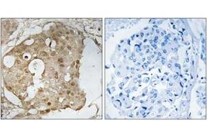 Immunohistochemistry analysis of paraffin-embedded human breast carcinoma, using p53 (Phospho-Ser366) Antibody. (p53 Antikörper  (pSer366))