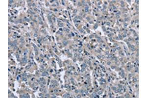 The image on the left is immunohistochemistry of paraffin-embedded Human liver cancer tissue using ABIN7129455(FAR2 Antibody) at dilution 1/50, on the right is treated with fusion protein. (FAR2 Antikörper)