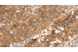Immunohistochemistry of paraffin-embedded Human breast cancer using PDLIM4 Polyclonal Antibody at dilution of 1:30 (PDLIM4 Antikörper)