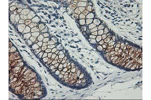Immunohistochemical staining of paraffin-embedded Adenocarcinoma of Human ovary tissue using anti-PVRL1 mouse monoclonal antibody. (PVRL1 Antikörper)