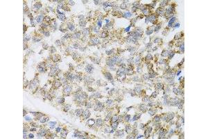 Immunohistochemistry of paraffin-embedded Human esophageal cancer using ZAK Polyclonal Antibody at dilution of 1:100 (40x lens). (ZAK Antikörper)