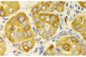 Immunohistochemistry of paraffin-embedded Human liver cancer using LRPAP1 Polyclonal Antibody at dilution of 1:100 (40x lens). (LRPAP1 Antikörper)