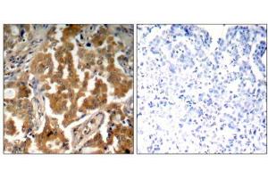 Immunohistochemical analysis of paraffin- embedded human lung carcinoma tissue using ADD1 (Phospho- Ser726) antibody (E011182). (alpha Adducin Antikörper  (pSer726))