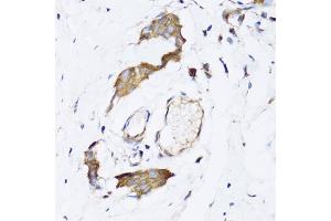 Immunohistochemistry of paraffin-embedded human breast cancer using NAA10 antibody (ABIN5974216) at dilution of 1/100 (40x lens). (NAA10 Antikörper)