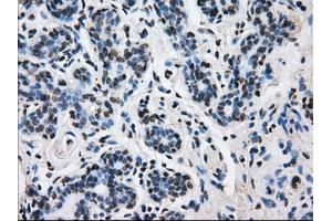 Immunohistochemical staining of paraffin-embedded breast tissue using anti-L1CAM mouse monoclonal antibody. (L1CAM Antikörper)
