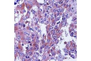 CD55 antibody immunohistochemistry analysis in formalin fixed and paraffin embedded human lung adenocarcinoma. (CD55 Antikörper  (AA 51-79))