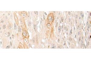 Immunohistochemistry of paraffin-embedded Human esophagus cancer tissue using DDX24 Polyclonal Antibody at dilution of 1:35(x200) (DDX24 Antikörper)