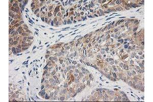 Immunohistochemical staining of paraffin-embedded Adenocarcinoma of Human breast tissue using anti-TOMM34 mouse monoclonal antibody. (TOMM34 Antikörper)