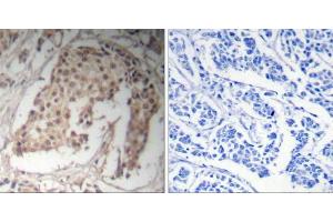 Immunohistochemical analysis of paraffin-embedded human breast carcinoma tissue using HNF4α (Ab-304) Antibody (E021043). (HNF4A Antikörper)