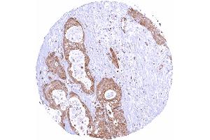 Pancreas Ductal adenocarcinoma with strong STING positivity of all tumor cells STING1 immunohistochemistry (STING1 (AA 190-290) Antikörper)