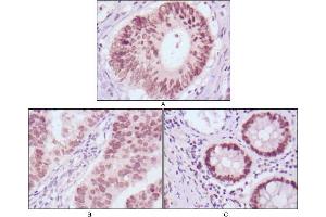 Immunohistochemical analysis of paraffin-embedded human colon cancer (A), gastric cancer (B) and rectal cancer (C) tissues using FOXA2 mouse mAb with DAB staining.