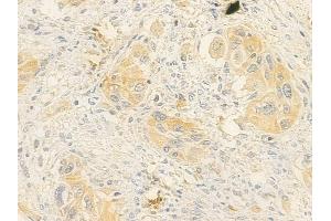 ABIN7095788 and ABIN7099850 at 1/100 staining human tongue carcinoma by IHC-P. (MEG3 Antikörper)