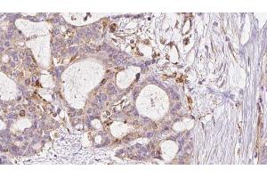 ABIN6273046 at 1/100 staining Human liver cancer tissue by IHC-P. (FAF2 Antikörper  (Internal Region))