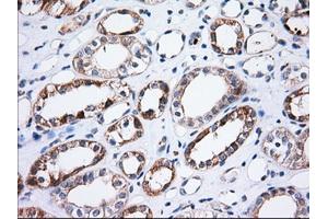 Immunohistochemical staining of paraffin-embedded Adenocarcinoma of Human ovary tissue using anti-TTC32 mouse monoclonal antibody. (TTC32 Antikörper)