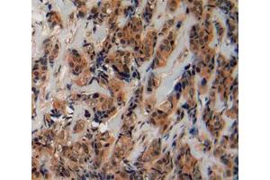 IHC-P analysis of breast cancer tissue, with DAB staining. (Fibrillin 2 Antikörper  (AA 1550-1791))