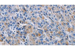 Immunohistochemistry of paraffin-embedded Human liver cancer tissue using RICTOR Polyclonal Antibody at dilution 1:50 (RICTOR Antikörper)