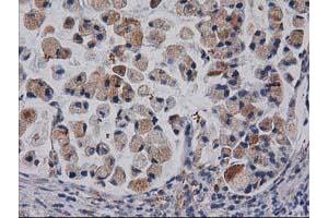 Immunohistochemical staining of paraffin-embedded Adenocarcinoma of Human colon tissue using anti-CDCP1 mouse monoclonal antibody. (CDCP1 Antikörper)
