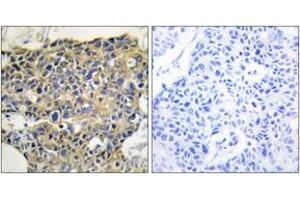 Immunohistochemistry analysis of paraffin-embedded human breast carcinoma, using EGFR (Phospho-Tyr1016) Antibody. (EGFR Antikörper  (pTyr1016))