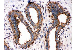 Anti-NF-kB p65 antibody, IHC(P) IHC(P): Human Mammary Cancer Tissue (NF-kB p65 Antikörper  (Middle Region))