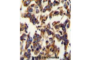 BSCL2 Antibody (N-term) immunohistochemistry analysis in formalin fixed and paraffin embedded human testis carcinoma followed by peroxidase conjugation of the secondary antibody and DAB staining. (BSCL2 Antikörper  (N-Term))