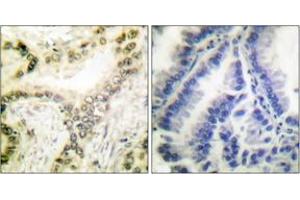 Immunohistochemistry analysis of paraffin-embedded human lung carcinoma tissue, using Histone H3 (Acetyl-Lys18) Antibody. (Histone 3 Antikörper  (H3K18ac))