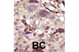 Formalin-fixed and paraffin-embedded human cancer tissue reacted with BTK polyclonal antibody  , which was peroxidase-conjugated to the secondary antibody, followed by DAB staining.
