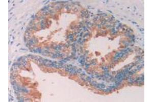 IHC-P analysis of Human Prostate Gland Tissue, with DAB staining. (SERPINA6 Antikörper  (AA 218-378))